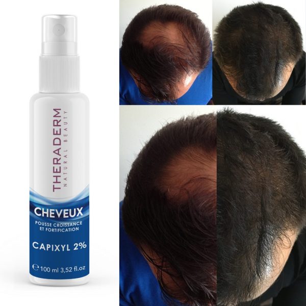 CHEVEUX POUSSE CROISSANCE ET FORTIFICATION CAPIXYL™ 2%